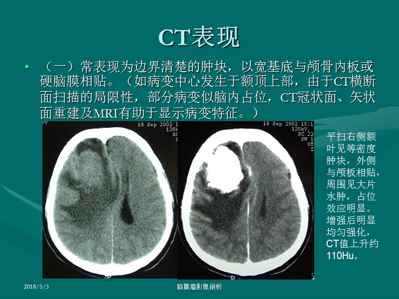 脑膜瘤ct、mri表现.ppt_第3页