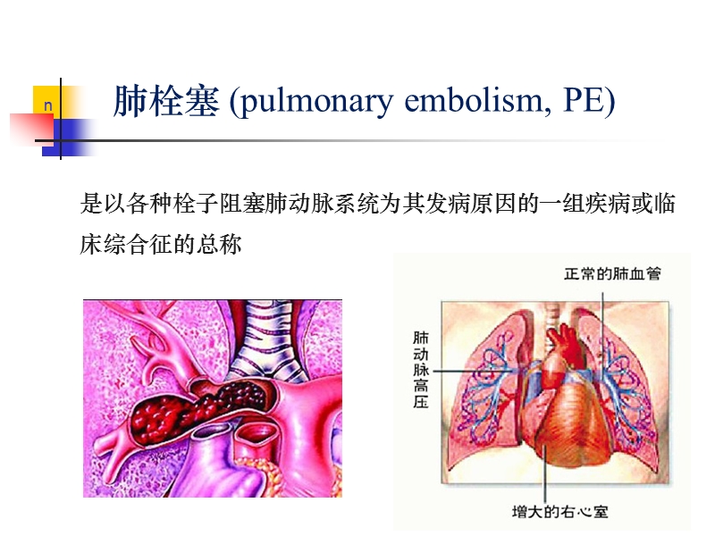 肺栓塞的发病机制、诊断和处理723.ppt_第2页