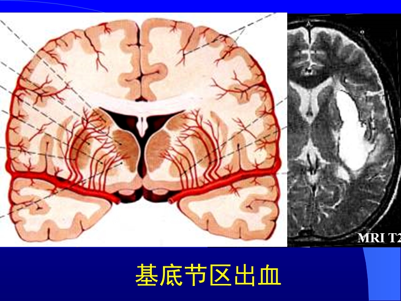 脑血管应解-.ppt_第3页