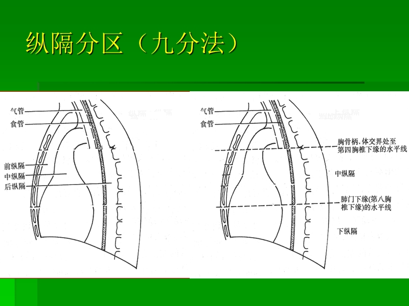 纵隔及心血管影诊基础.ppt_第3页