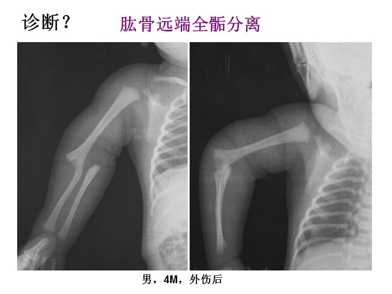 儿童骨骺损伤影像诊断(急) PPT.ppt_第2页