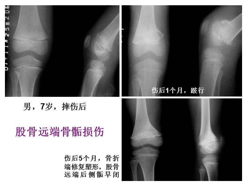 儿童骨骺损伤影像诊断(急) PPT.ppt_第3页