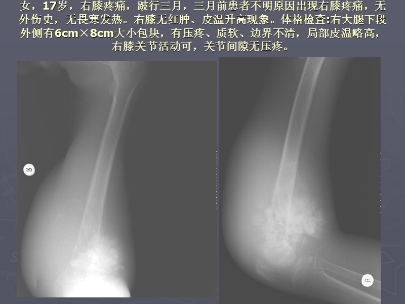 骨肉瘤x线诊断.ppt_第3页