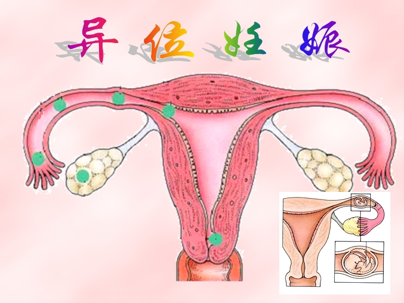 异位妊娠的护理.ppt_第3页