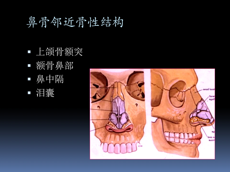 鼻骨骨折影像学诊断与鉴别(精品).ppt_第3页