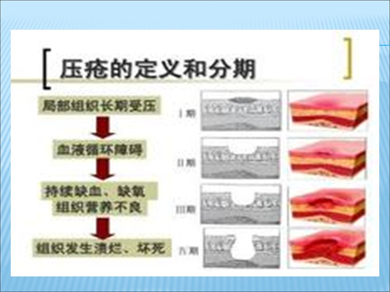 高危压疮患者健康宣教.pptx_第2页