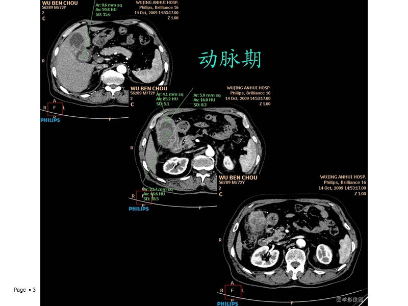 黄色肉芽肿性胆囊炎.ppt_第3页