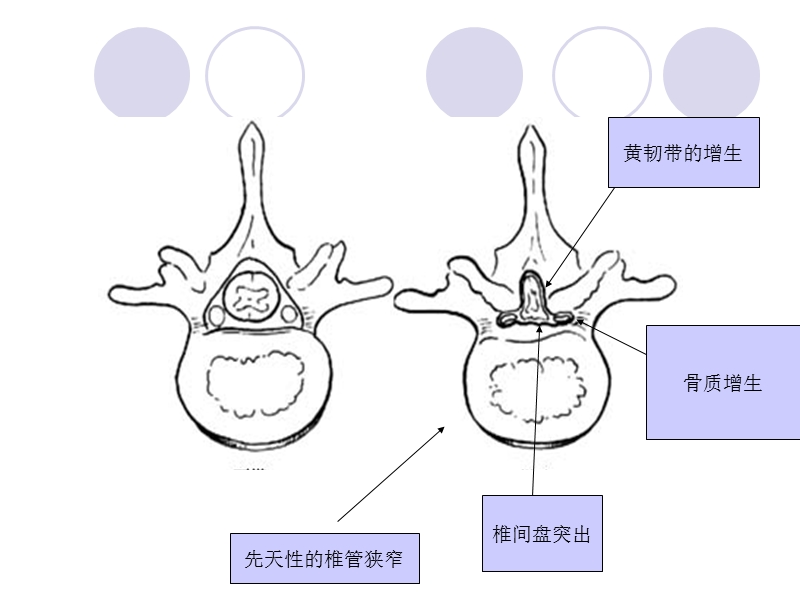 腰椎管狭窄症.ppt_第3页