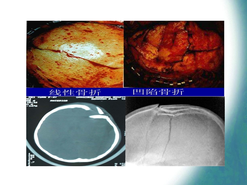 颅骨凹陷性骨折复.ppt_第3页