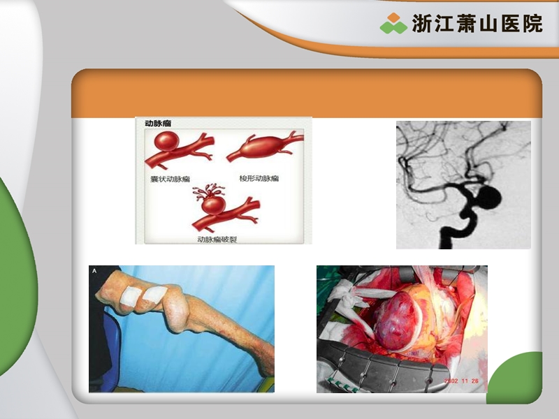动脉瘤与动脉夹层 浙江萧山医院.ppt_第3页