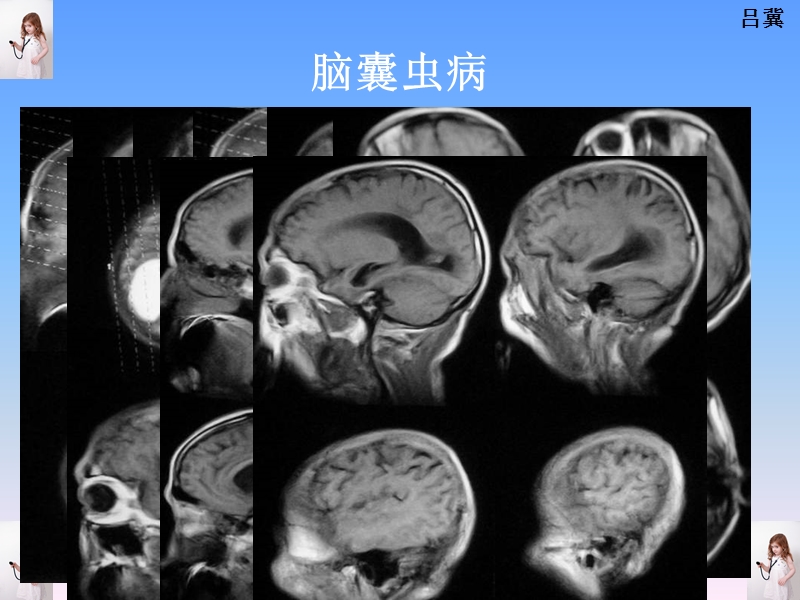 医影在线--CNS疾病影像图库(3).ppt_第3页