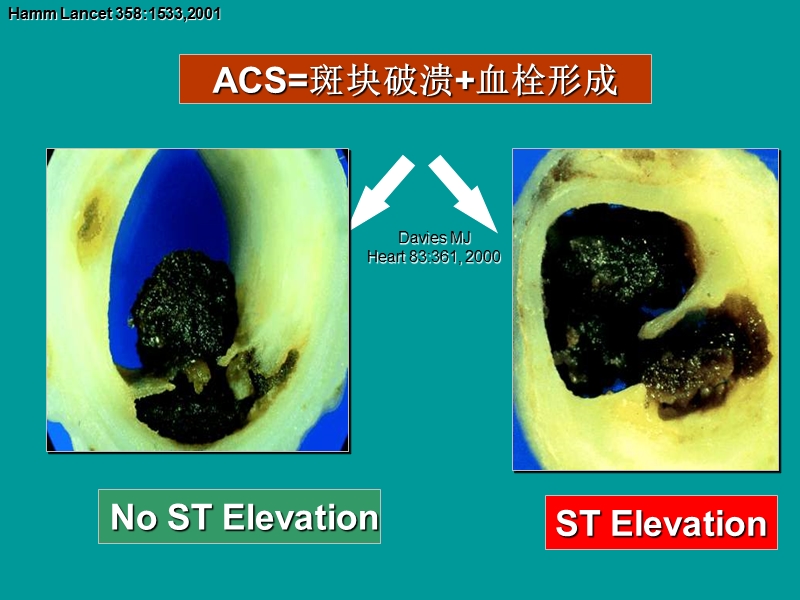 急性心肌梗死的规范治疗.ppt_第2页