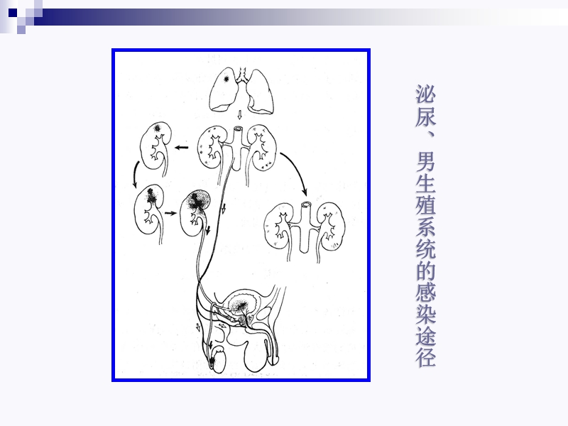 泌尿男生殖系统结核.ppt_第3页