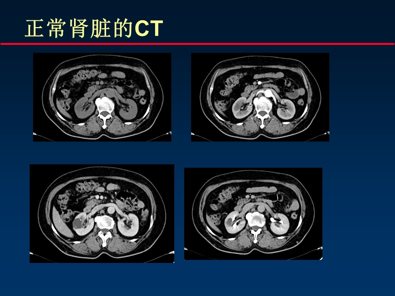 肾肿瘤的ct.ppt_第3页