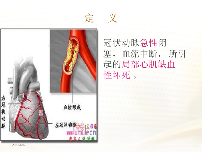 急性心肌梗死的急救护理27组 漳州卫生职业学院.ppt_第3页