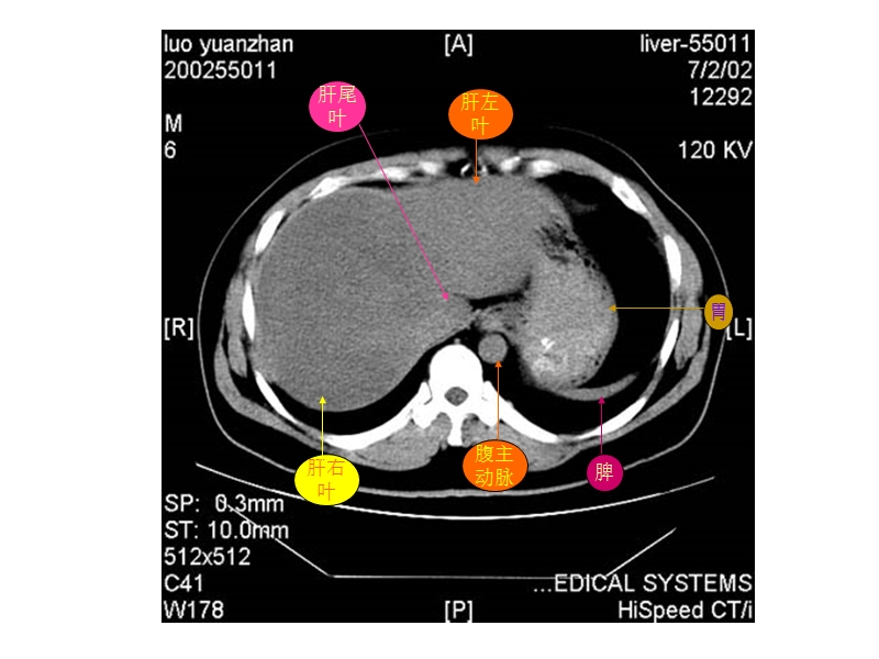 【共享】超好的腹部CT学习图片及PPT资料.ppt_第3页