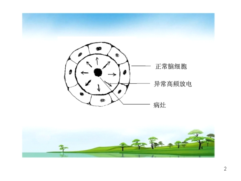 局限型癫痫的治疗措施.ppt_第2页