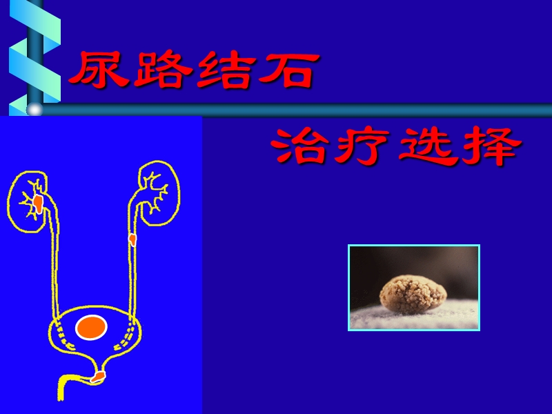 尿路结石luo.ppt_第1页